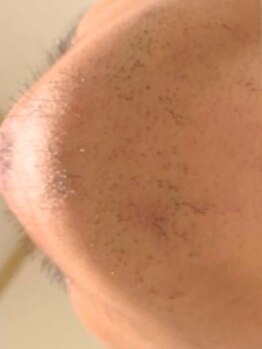 エム(M)の写真/【敏感肌の方もOK！】痛みが少なく効果を実感いただける冷却脱毛マシンを使用！脱毛が初めての方にも◎