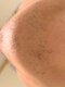 エム(M)の写真/【敏感肌の方もOK！】痛みが少なく効果を実感いただける冷却脱毛マシンを使用！脱毛が初めての方にも◎