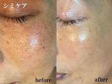 カピリナ(KA PILINA)/シミケアからの肌変化☆