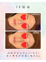 リリアン(lirien)/毛穴/毛穴ケア/毛穴洗浄/駒込