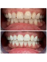 エクシアホワイトニング 日本橋店/人形町ホワイトニング