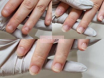 深爪矯正before&after