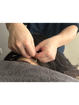 鍼灸施術を受けたい