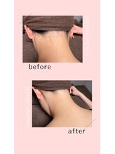 サロンド ピーチ(SALOND PEACH)/人気な部位うなじ脱毛♪