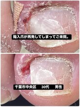 巻き爪じゅん 船橋店/陥入爪の痛みが再発でご来院