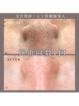 ベルミー(Bellmi)/毛穴洗浄×ヒト幹細胞導入