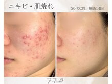 スリースリー(THREE THREE)/ニキビ・肌荒れケア