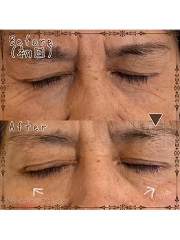 プライベートサロン レイ(Ray)/カスタマイズコース目元シワ改善