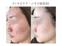 エピア 豊田店(Epia)/大人ニキビケア・赤み痕ケア