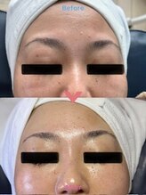 ミルキー(Milky)/お肌にハリを与えるスノーピール