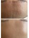 エルアンドエル(L&L)の写真/【本気の肌質改善◎】素肌美人を叶えるサロン!肌質に合わせてプロが調合したハーブピーリングをご用意♪