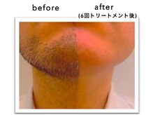 アイブロウサロン アヴィ(A‘VI)/【メンズ脱毛】髭脱毛★新潟
