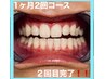 圧倒的白さ！歯のセルフホワイトニング！１ヶ月に2回コース！！7500円！！