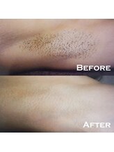 オーシャンブルー 佐世保店(OCEAN BLUE)/結果の出る脱毛【ワキ】