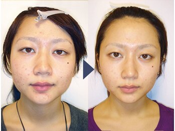 美デザイン 上野店(美.design)/☆小顔矯正+頭蓋骨矯正