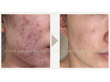 【5か月間の結果】　理想の肌へと導く肌質改善フェイシャル