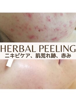 ジュノー ビューティー 綾瀬店(Juno Beauty)/ハーブピーリングで肌質改善
