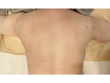 モネ(monet)/跡、色ムラにお悩みの方