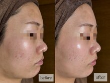 ヒナノ 矢場町店(HINANO)/クリスティーナビオフィート