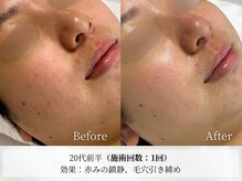 アストリエ グレース 相模大野(Astorie Grace)/ハーブピーリング1回でも効果◎