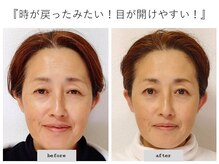 エピファニー(Epiphany)/50代　目が重い、たるみが悩みで