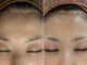 ミューク 自由が丘(mjuk)の写真/細胞活性化セルラムでハリツヤUP！おでこのしわ改善へ導き、輝く印象へ♪