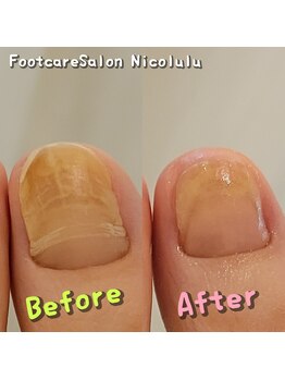 ニコルル 大阪天満店(Nicolulu)/分厚い爪！肥厚爪！