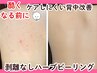【背中上部/下部】剥離なしハーブピーリング☆ニキビケア