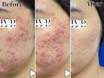 ラヴレボーテ(La Vraie Beaute)/20代・ニキビ・改善期間8ヶ月