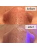 【大人気】\毛穴の大掃除/顔全体毛穴洗浄コース60分¥8000→¥6000