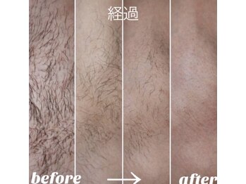 ヴィテラス バイ アリア(Veteras by aria)/☆脱毛完了までの流れ☆