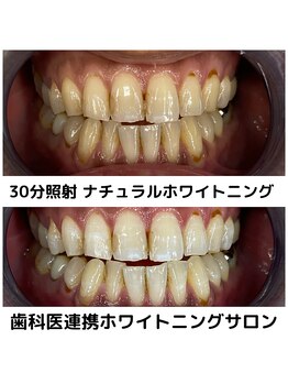 プラチナムビューティ 四条烏丸店(PLATINUM Beauty)/ホワイトニング！Before./After!