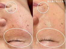 ラエッセ 恵比寿(LAESSE)/毛穴・美白専門店 LAESSE 恵比寿