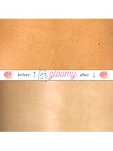 グルーミー(gloomy)/トーンUP☆背中のWAX脱毛☆