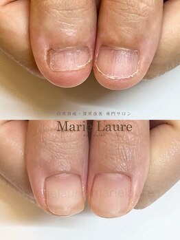 マリーロール 淀屋橋本店(Marie Laure)/自爪育成/深爪矯正/ネイルケア