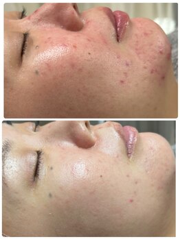 チュチュ(TUTU)/赤み・ニキビ改善