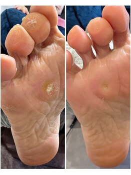 ケアプラス(care plus)/タコ・ウオノメケア