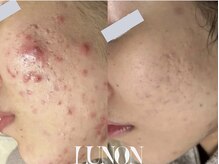 ルノン(Lunon)/肌質改善　《途中経過》