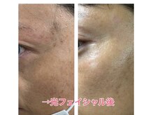 ソライロの雰囲気（光フェイシャルのビフォーアフターです♪　）