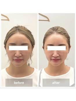 オルネ(ORNE.)の写真/小顔にするのが得意なサロン◇◇小顔フラクショナルと美顔調整の組み合わせがおすすめ◎