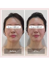 ディードットアン(D.an)/小顔コルギ