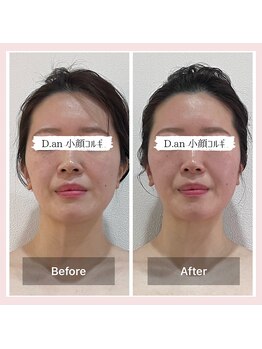 ディードットアン(D.an)/小顔コルギ