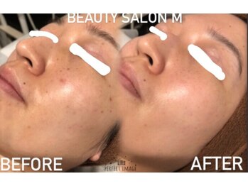 エム(M)/シミケア症例