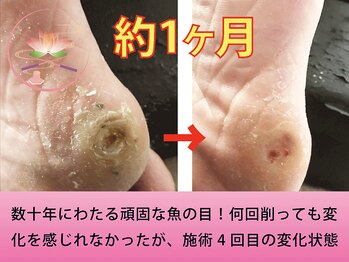 健美庵/長年にわたる魚の目