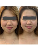 リノア 堀江(Linoa)/たるみケア