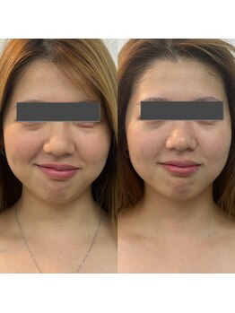 リノア 堀江(Linoa)/たるみケア