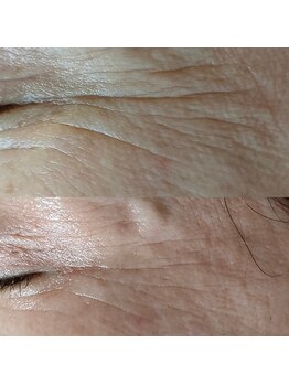 シエスタ 新小岩/しわ改善には持続型レチノール！