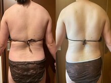 サラン鍼灸院(SARAN都楽鍼灸院)/よもぎ蒸し×エンダモロジー結果