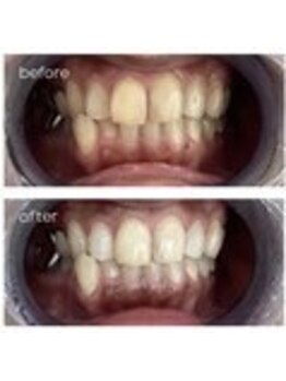 エクシアホワイトニング 津駅前店/お客様ビフォーアフター