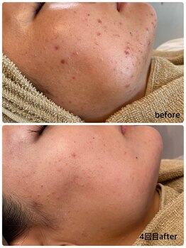 フェリシダージ(felicidade)/ハーブピーリング4回